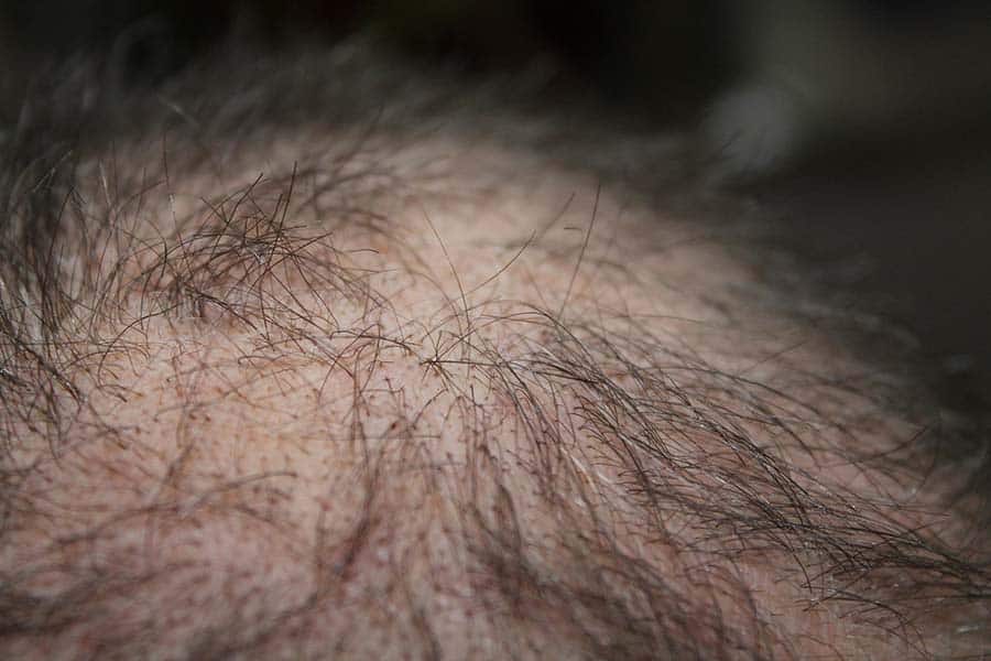 How To Grow Back Hair That Has Been Pulled Out